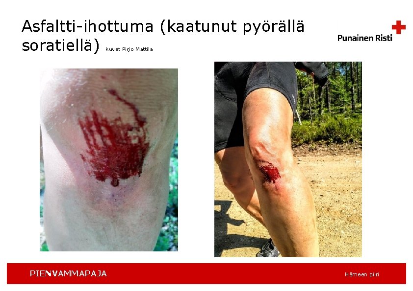 Asfaltti-ihottuma (kaatunut pyörällä soratiellä) kuvat Pirjo Mattila PIENVAMMAPAJA Hämeen piiri 