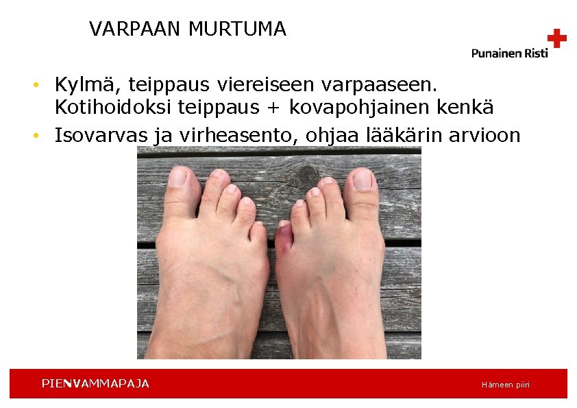 VARPAAN MURTUMA • Kylmä, teippaus viereiseen varpaaseen. Kotihoidoksi teippaus + kovapohjainen kenkä • Isovarvas