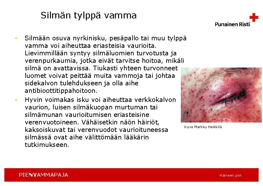 Silmän tylppä vamma • • Silmään osuva nyrkinisku, pesäpallo tai muu tylppä vamma voi