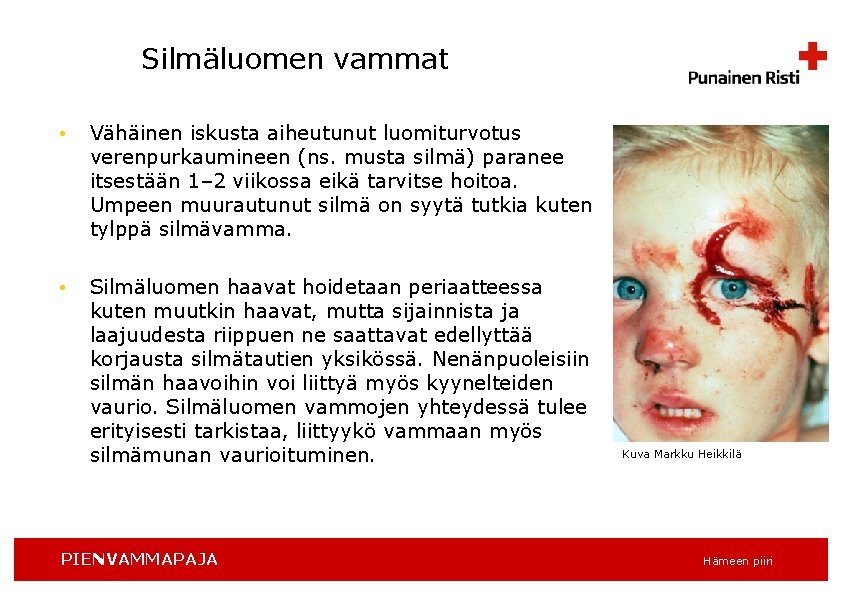 Silmäluomen vammat • Vähäinen iskusta aiheutunut luomiturvotus verenpurkaumineen (ns. musta silmä) paranee itsestään 1–