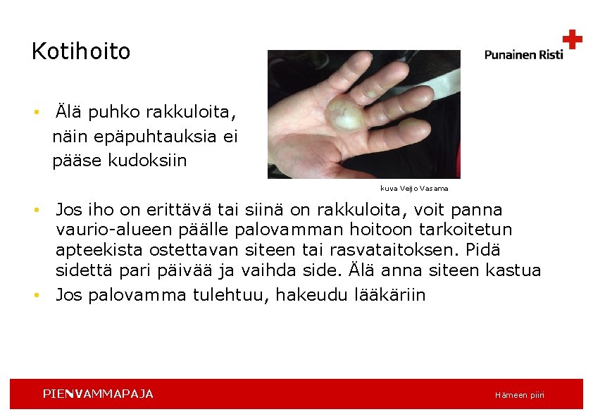 Kotihoito • Älä puhko rakkuloita, näin epäpuhtauksia ei pääse kudoksiin kuva Veijo Vasama •