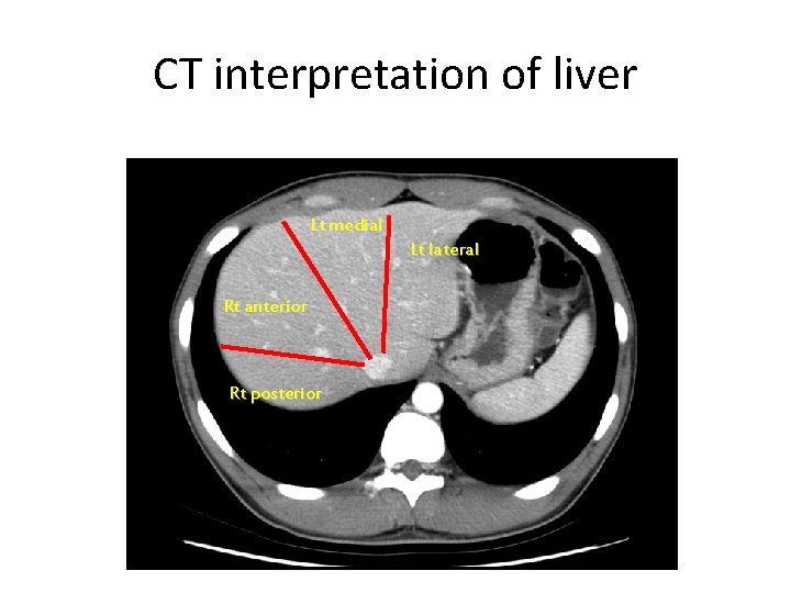 CT interpretation of liver Lt medial Lt lateral Rt anterior Rt posterior 