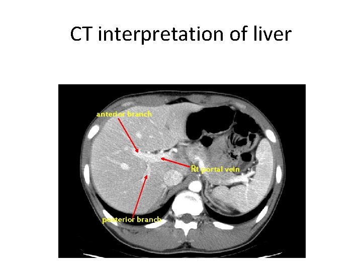 CT interpretation of liver anterior branch Rt portal vein posterior branch 