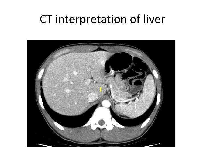 CT interpretation of liver I 