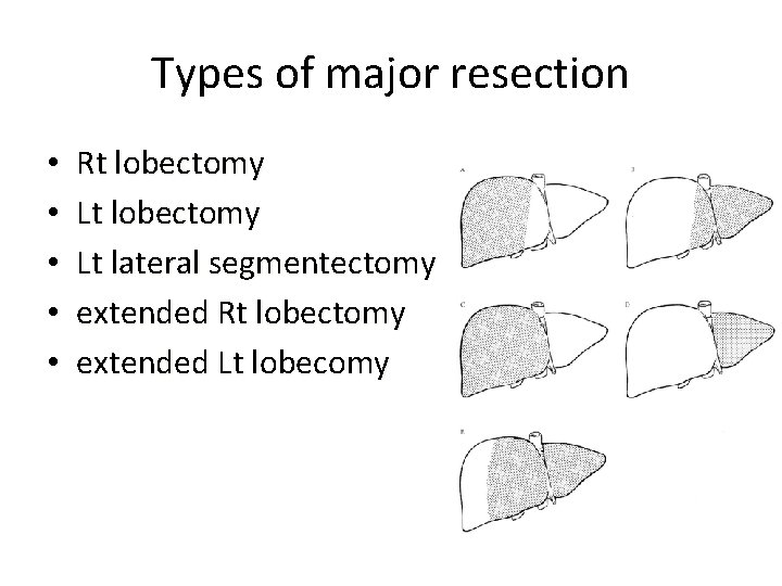 Types of major resection • • • Rt lobectomy Lt lateral segmentectomy extended Rt