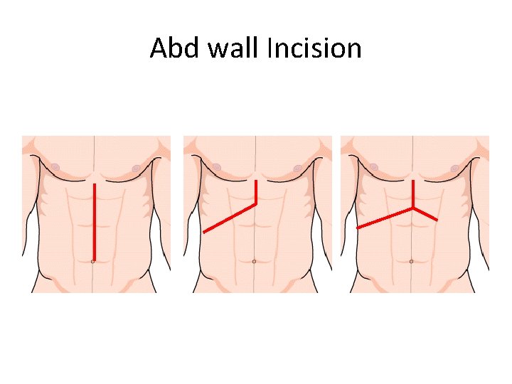 Abd wall Incision 