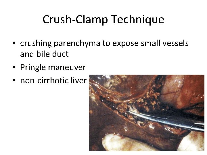 Crush-Clamp Technique • crushing parenchyma to expose small vessels and bile duct • Pringle