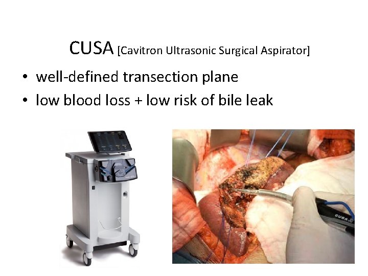 CUSA [Cavitron Ultrasonic Surgical Aspirator] • well-defined transection plane • low blood loss +