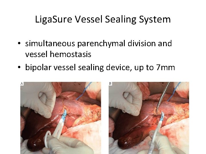 Liga. Sure Vessel Sealing System • simultaneous parenchymal division and vessel hemostasis • bipolar