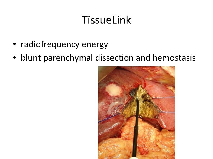 Tissue. Link • radiofrequency energy • blunt parenchymal dissection and hemostasis 