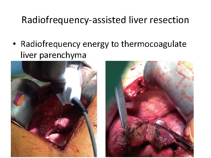 Radiofrequency-assisted liver resection • Radiofrequency energy to thermocoagulate liver parenchyma • higher complication rate