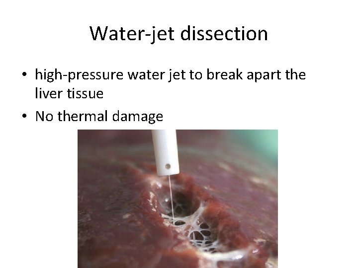 Water-jet dissection • high-pressure water jet to break apart the liver tissue • No