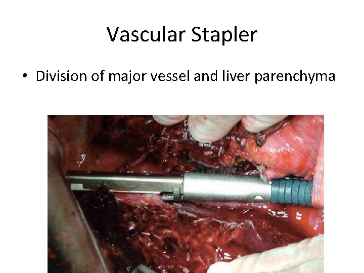 Vascular Stapler • Division of major vessel and liver parenchyma 