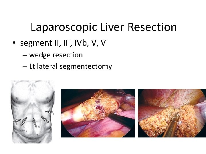 Laparoscopic Liver Resection • segment II, IVb, V, VI – wedge resection – Lt