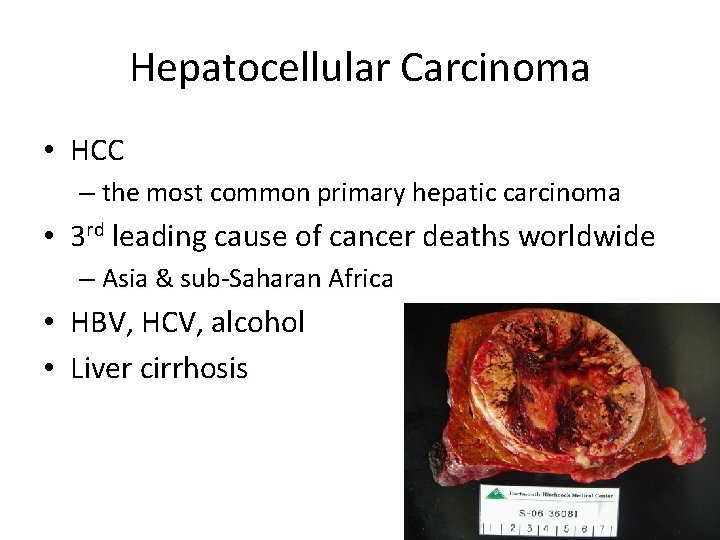 Hepatocellular Carcinoma • HCC – the most common primary hepatic carcinoma • 3 rd