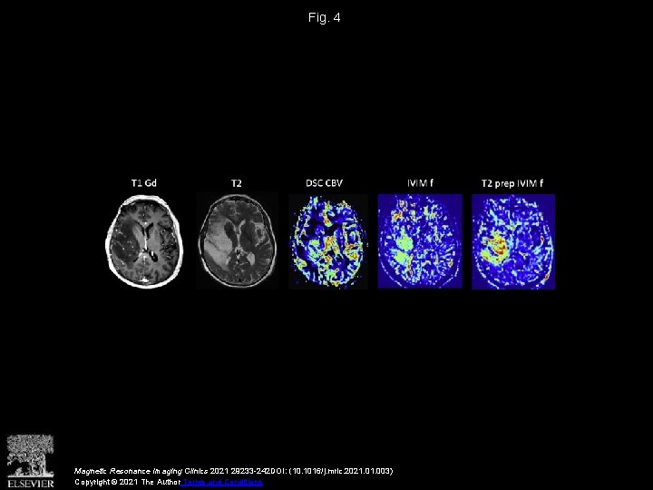 Fig. 4 Magnetic Resonance Imaging Clinics 2021 29233 -242 DOI: (10. 1016/j. mric. 2021.