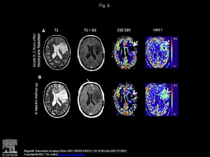 Fig. 6 Magnetic Resonance Imaging Clinics 2021 29233 -242 DOI: (10. 1016/j. mric. 2021.