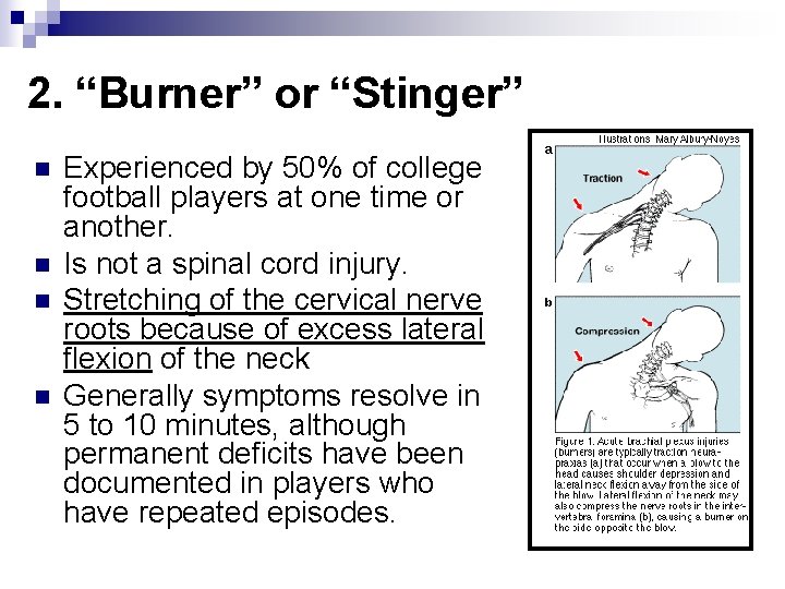 2. “Burner” or “Stinger” n n Experienced by 50% of college football players at