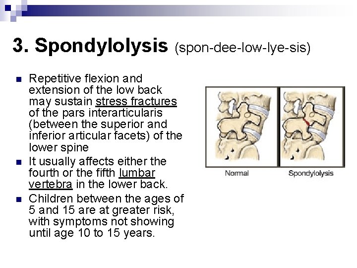 3. Spondylolysis (spon-dee-low-lye-sis) n n n Repetitive flexion and extension of the low back