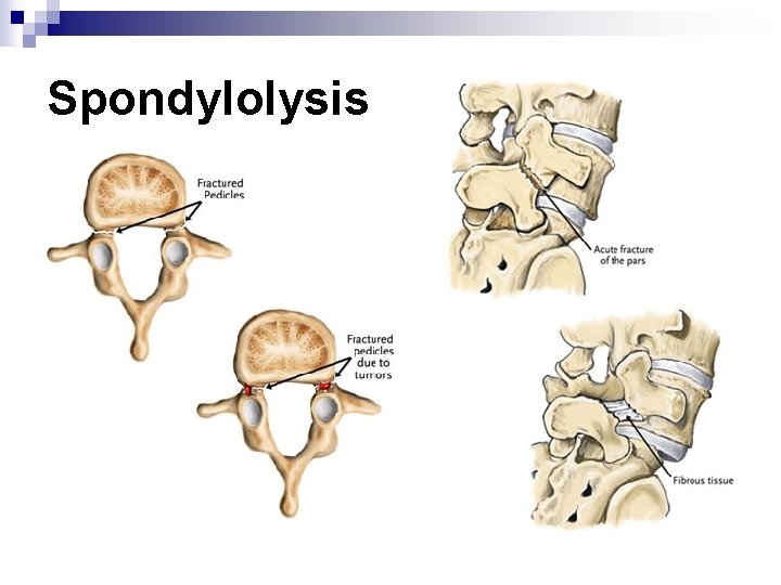 Spondylolysis 