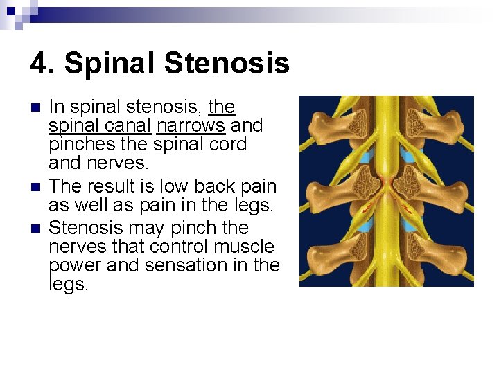 4. Spinal Stenosis n n n In spinal stenosis, the spinal canal narrows and