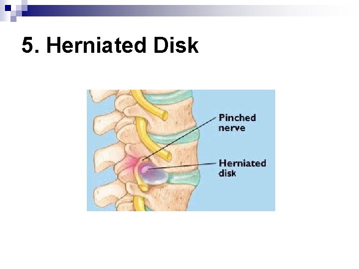 5. Herniated Disk 