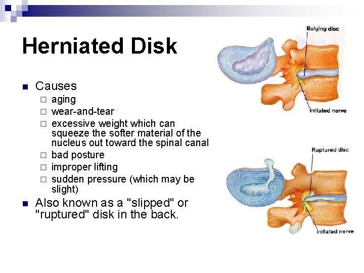 Herniated Disk n Causes aging wear-and-tear excessive weight which can squeeze the softer material