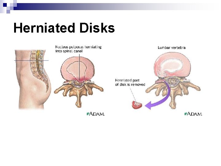 Herniated Disks 