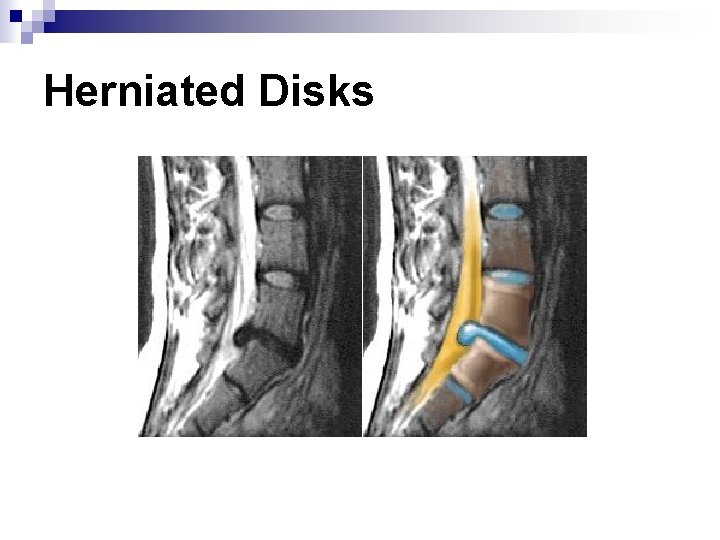 Herniated Disks 