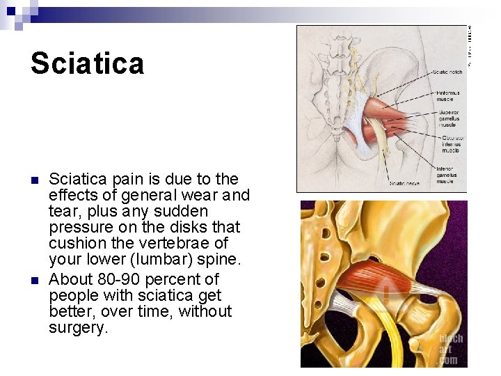 Sciatica n n Sciatica pain is due to the effects of general wear and