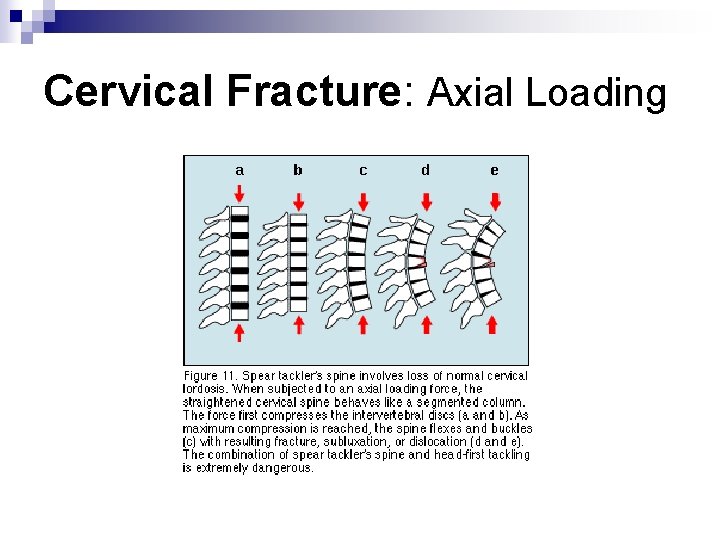 Cervical Fracture: Axial Loading 