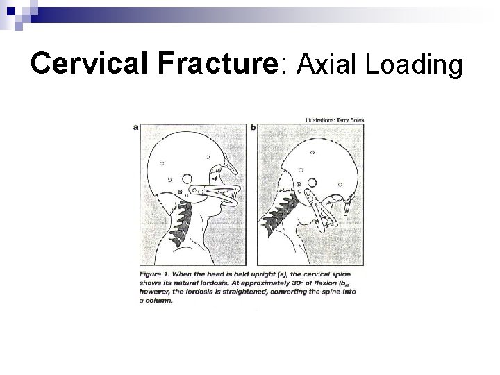 Cervical Fracture: Axial Loading 