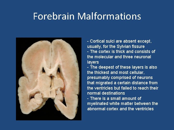 Forebrain Malformations - Cortical sulci are absent except, usually, for the Sylvian fissure -