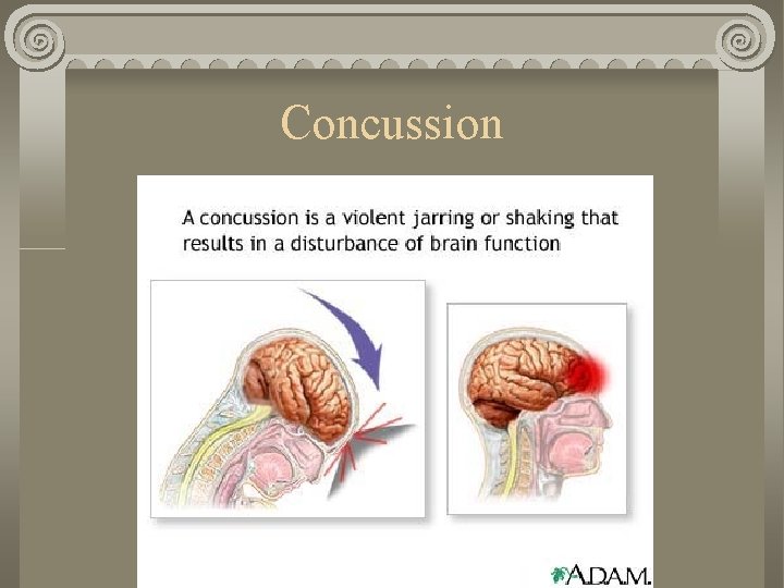 Concussion Concussion