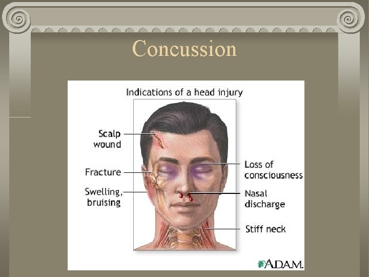 Concussion Concussion