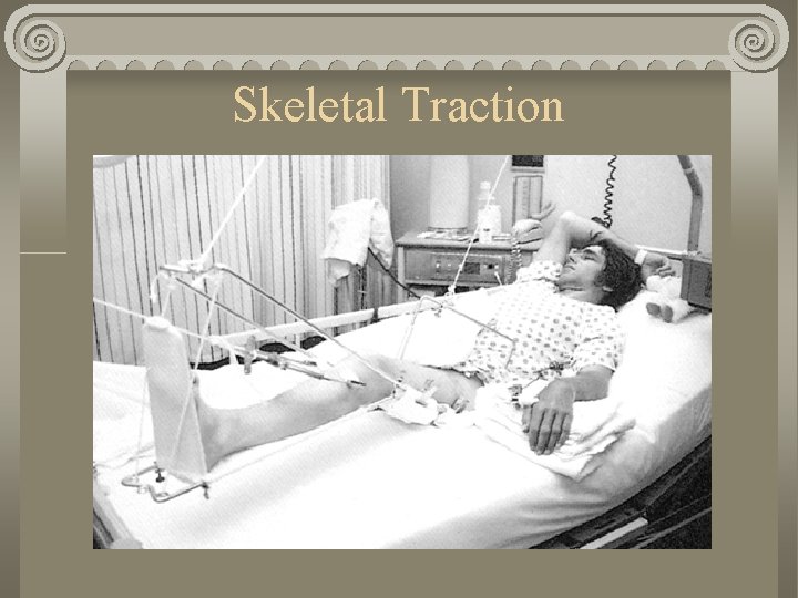 Skeletal Traction Skeletal Traction