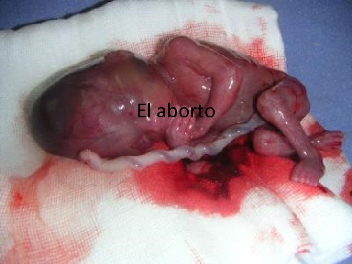 El aborto 