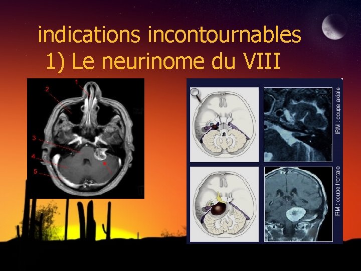 indications incontournables 1) Le neurinome du VIII 