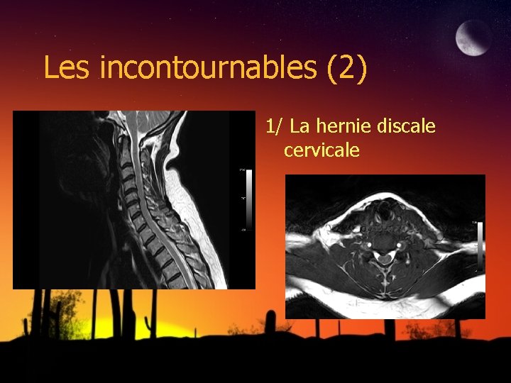 Les incontournables (2) 1/ La hernie discale cervicale 