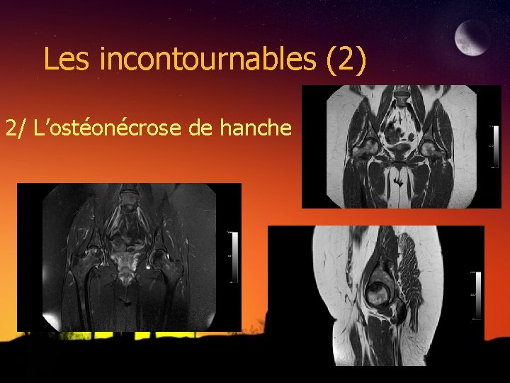 Les incontournables (2) 2/ L’ostéonécrose de hanche 