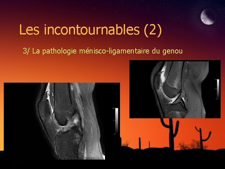 Les incontournables (2) 3/ La pathologie ménisco-ligamentaire du genou 