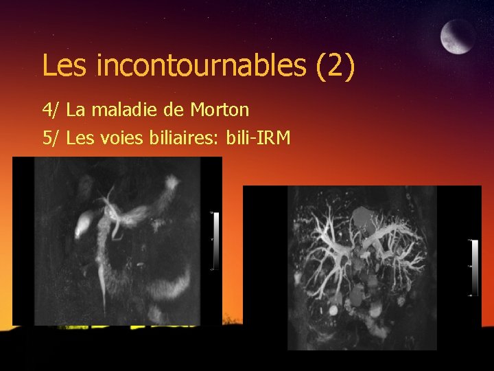 Les incontournables (2) 4/ La maladie de Morton 5/ Les voies biliaires: bili-IRM 