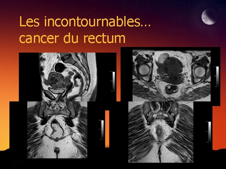 Les incontournables… cancer du rectum 
