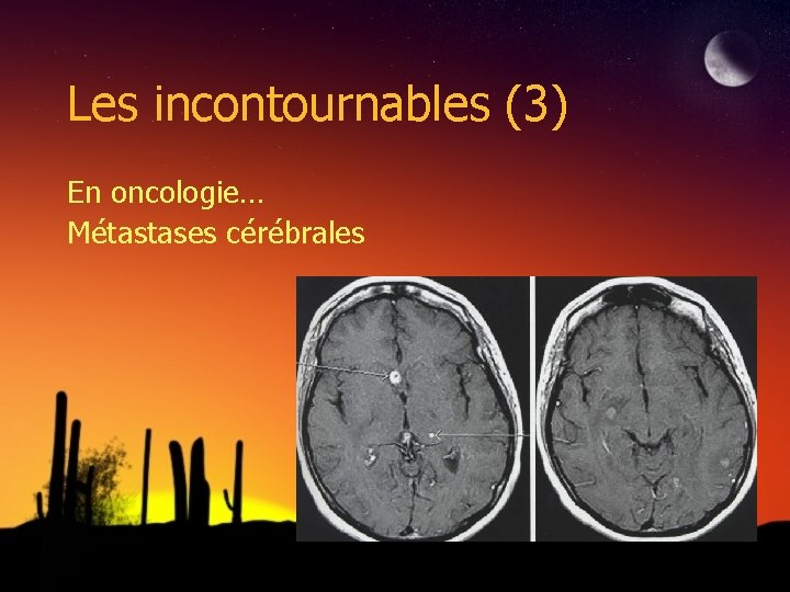 Les incontournables (3) En oncologie… Métastases cérébrales 