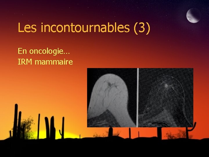 Les incontournables (3) En oncologie… IRM mammaire 