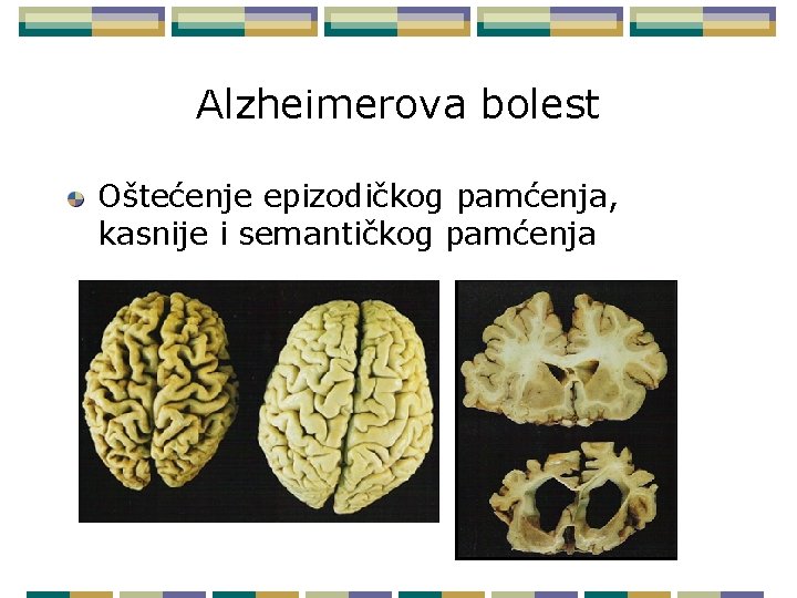 Alzheimerova bolest Oštećenje epizodičkog pamćenja, kasnije i semantičkog pamćenja 