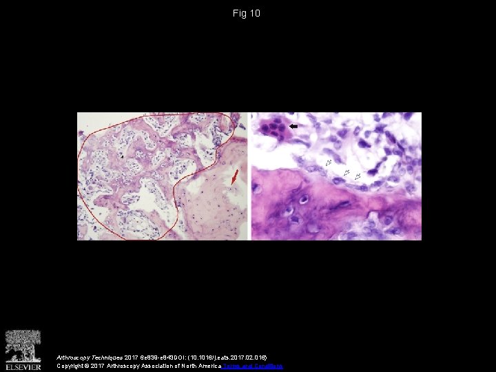 Arthroscopic Excision of Osteoid Osteoma of the Talus