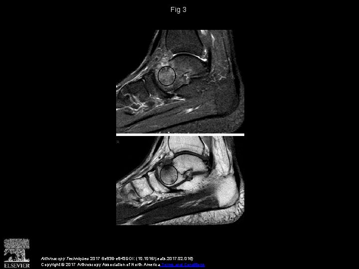 Arthroscopic Excision of Osteoid Osteoma of the Talus