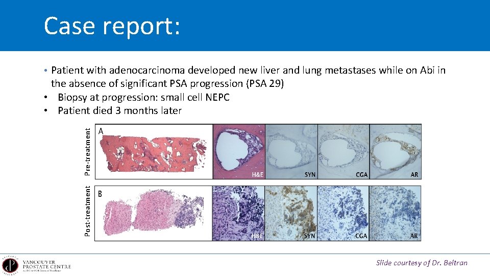 Case report: • Patient with adenocarcinoma developed new liver and lung metastases while on