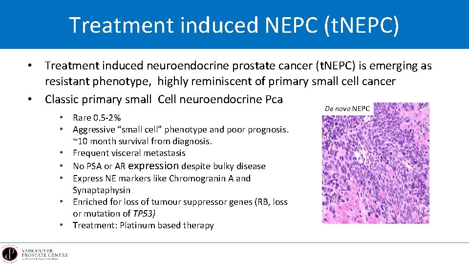 Treatment induced NEPC (t. NEPC) • Treatment induced neuroendocrine prostate cancer (t. NEPC) is